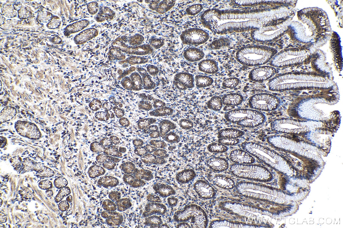 Immunohistochemical analysis of paraffin-embedded human stomach cancer tissue slide using KHC1111 (CRISP3 IHC Kit).