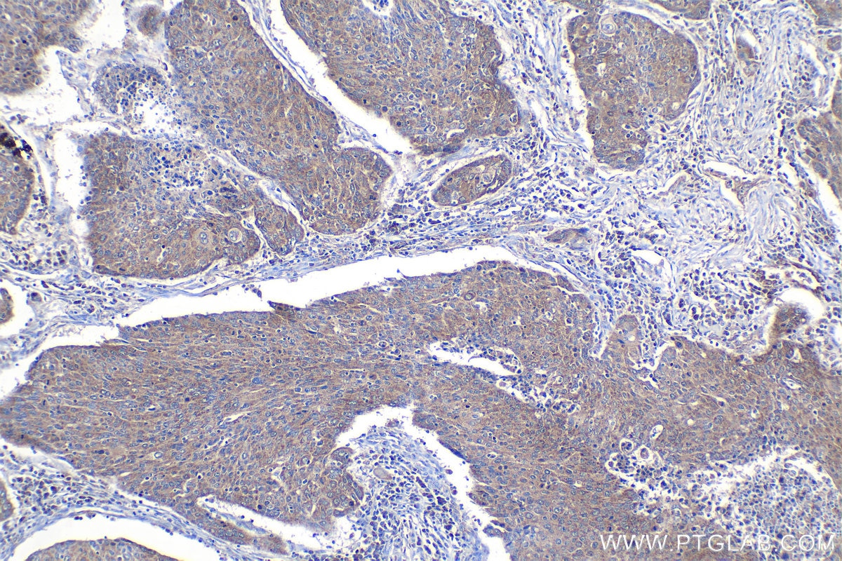 Immunohistochemical analysis of paraffin-embedded human lung cancer tissue slide using KHC1360 (CRLS1 IHC Kit).