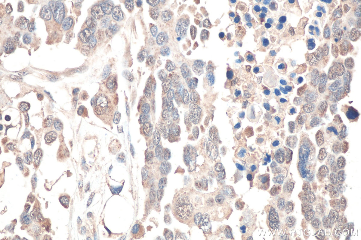Immunohistochemical analysis of paraffin-embedded human colon cancer tissue slide using KHC0802 (CRTC1 IHC Kit).
