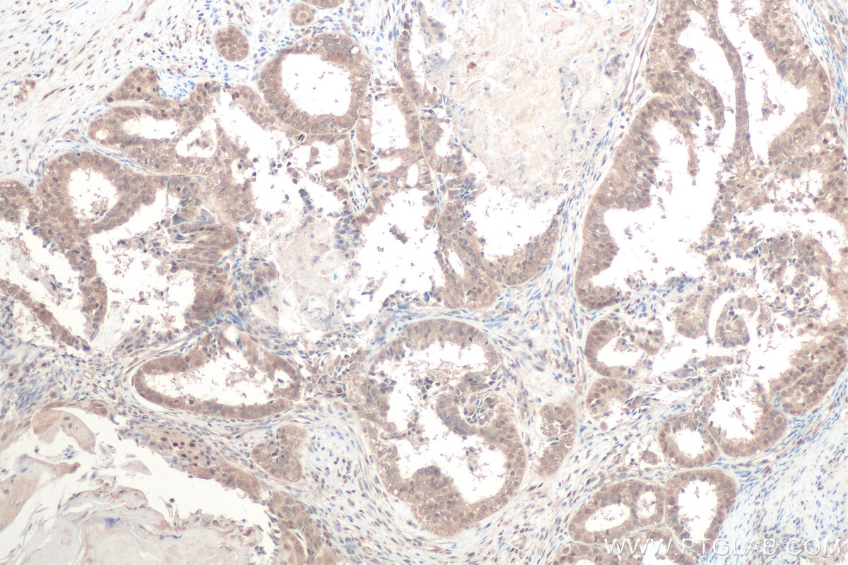 Immunohistochemical analysis of paraffin-embedded human ovary tumor tissue slide using KHC0802 (CRTC1 IHC Kit).