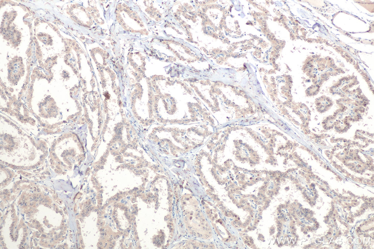 Immunohistochemical analysis of paraffin-embedded human thyroid cancer tissue slide using KHC0802 (CRTC1 IHC Kit).