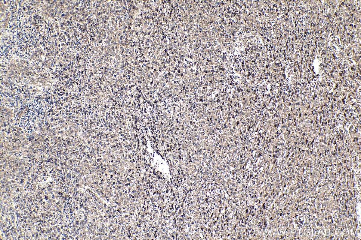 Immunohistochemical analysis of paraffin-embedded human cervical cancer tissue slide using KHC1792 (CRTC3 IHC Kit).