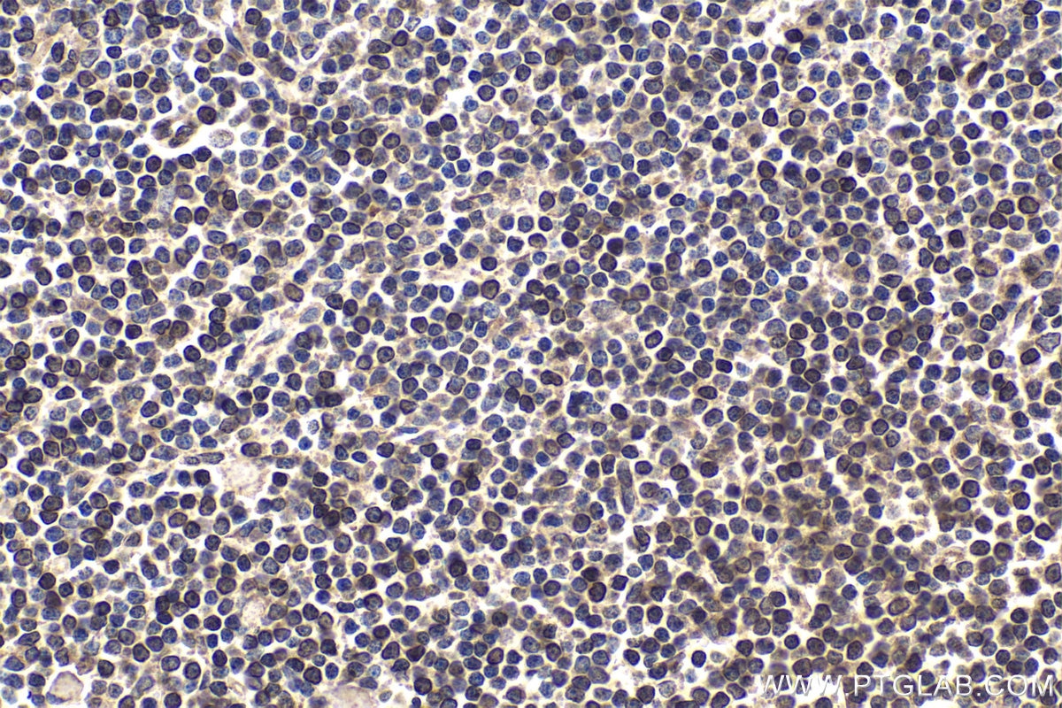 Immunohistochemical analysis of paraffin-embedded human lymphoma tissue slide using KHC1792 (CRTC3 IHC Kit).