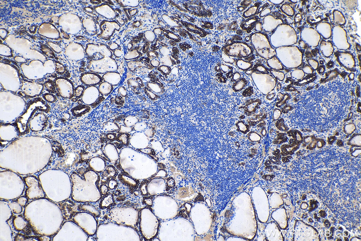 Immunohistochemical analysis of paraffin-embedded human thyroid cancer tissue slide using KHC1503 (CRYAB IHC Kit).