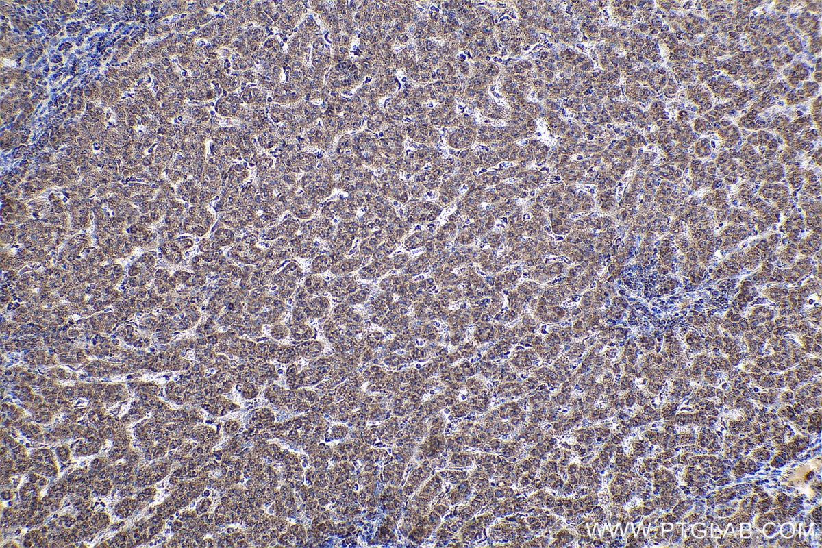 Immunohistochemical analysis of paraffin-embedded human liver cancer tissue slide using KHC0877 (CS IHC Kit).