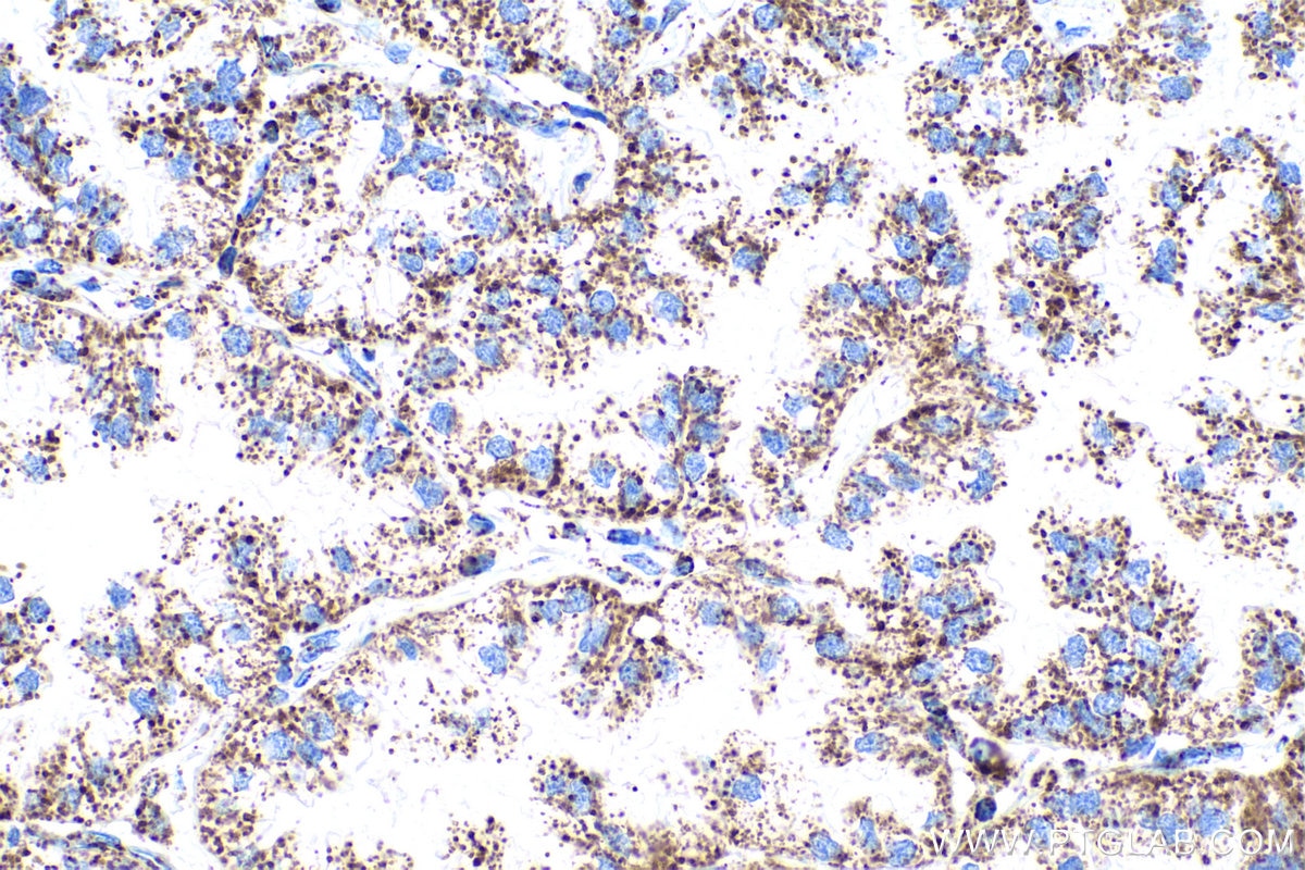 Immunohistochemical analysis of paraffin-embedded human lung cancer tissue slide using KHC0877 (CS IHC Kit).