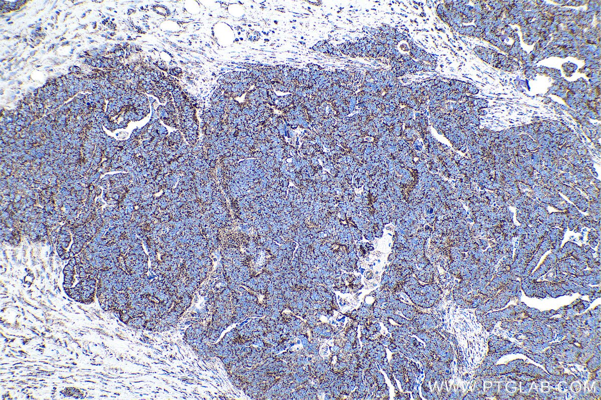 Immunohistochemical analysis of paraffin-embedded human ovary tumor tissue slide using KHC0877 (CS IHC Kit).