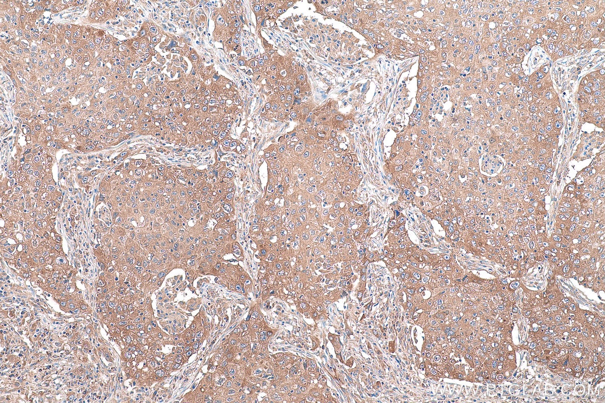 Immunohistochemical analysis of paraffin-embedded human lung cancer tissue slide using KHC0902 (CSDE1 IHC Kit).