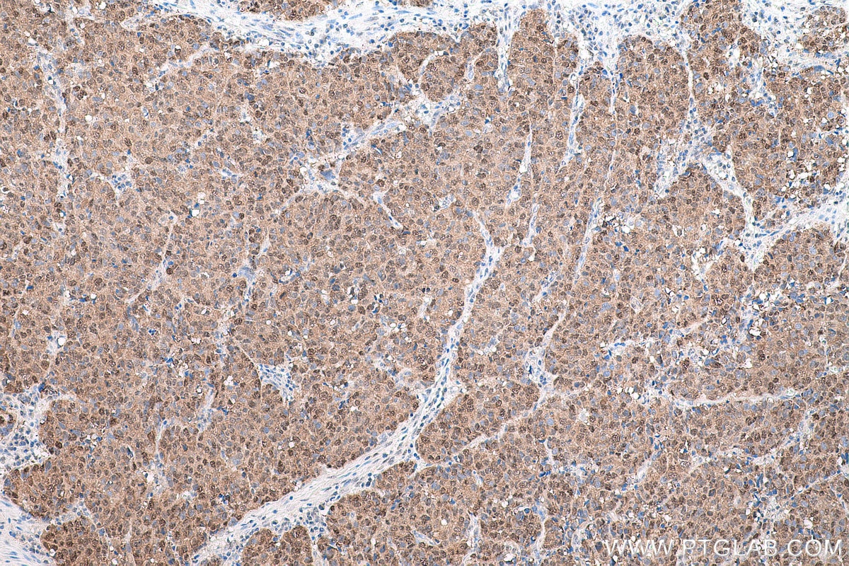 Immunohistochemical analysis of paraffin-embedded human stomach cancer tissue slide using KHC0779 (CSE1L IHC Kit).