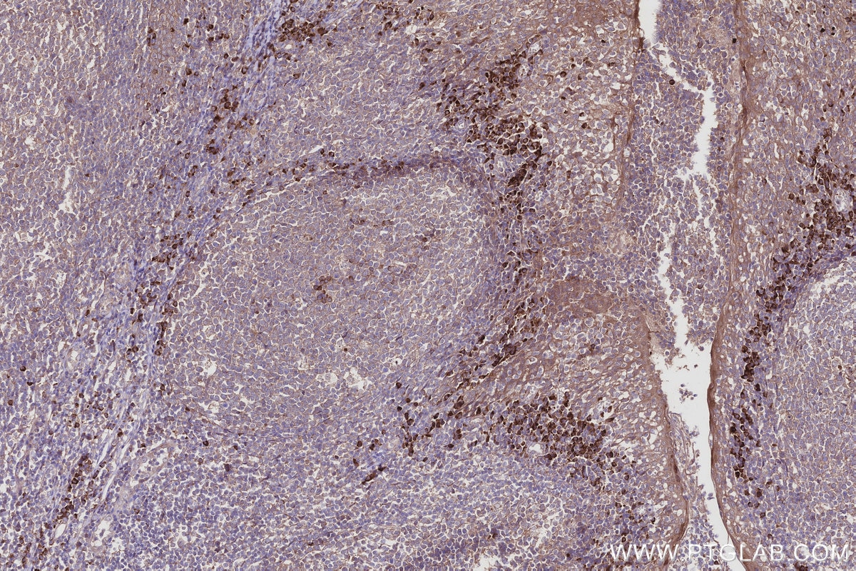 Immunohistochemical analysis of paraffin-embedded human tonsillitis tissue slide using KHC2932 (CSNK1G1 IHC Kit).
