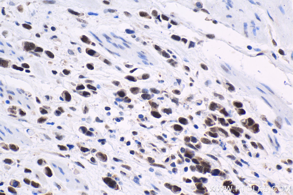 Immunohistochemical analysis of paraffin-embedded human stomach cancer tissue slide using KHC1651 (CSNK2A1 IHC Kit).