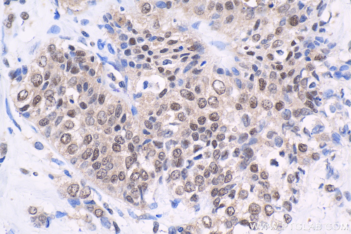 Immunohistochemical analysis of paraffin-embedded human urothelial carcinoma tissue slide using KHC1651 (CSNK2A1 IHC Kit).