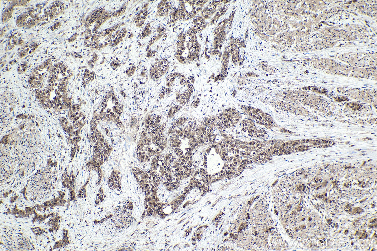 Immunohistochemical analysis of paraffin-embedded human urothelial carcinoma tissue slide using KHC1650 (CSNK2B IHC Kit).