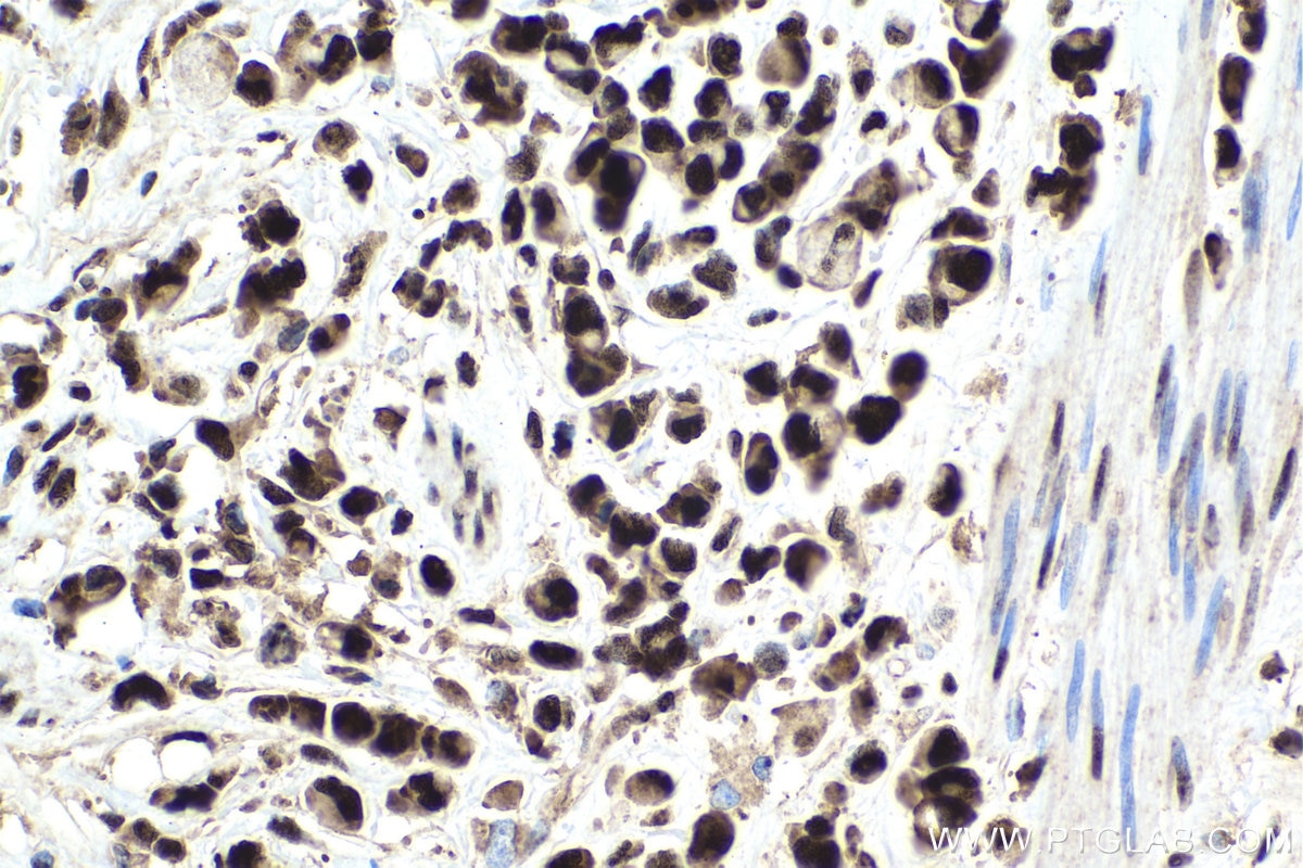 Immunohistochemical analysis of paraffin-embedded human stomach cancer tissue slide using KHC1650 (CSNK2B IHC Kit).