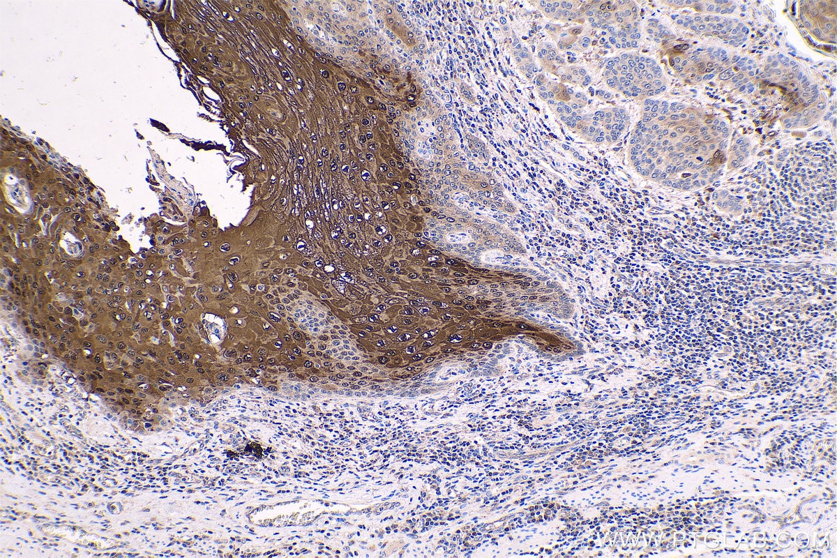 Immunohistochemical analysis of paraffin-embedded human oesophagus cancer tissue slide using KHC0577 (Cystatin B IHC Kit).