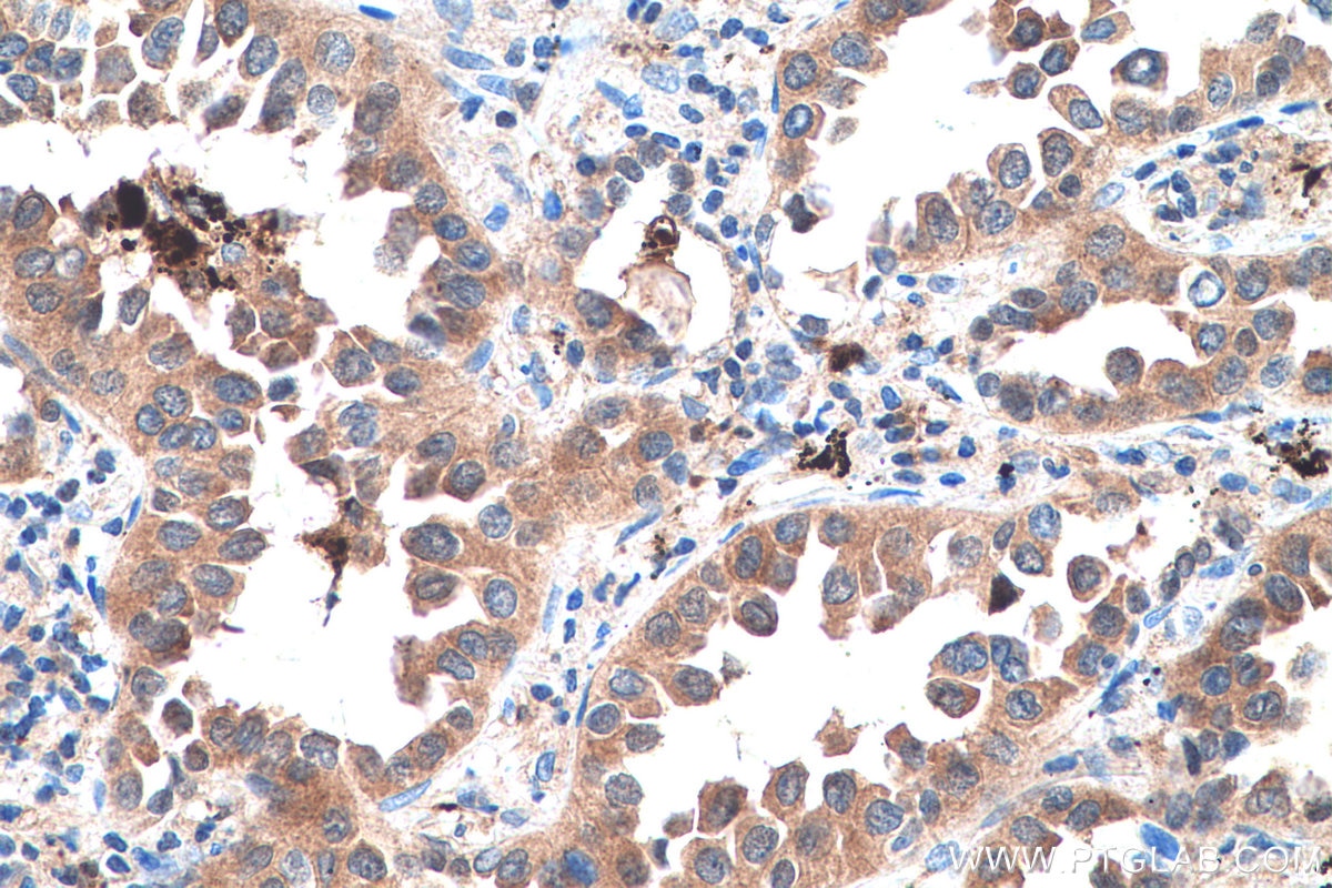 Immunohistochemical analysis of paraffin-embedded human lung cancer tissue slide using KHC0577 (Cystatin B IHC Kit).