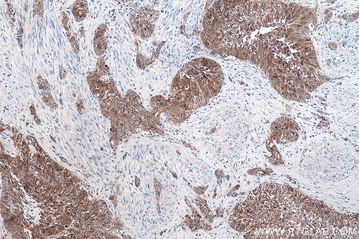 Immunohistochemical analysis of paraffin-embedded human urothelial carcinoma tissue slide using KHC0577 (Cystatin B IHC Kit).