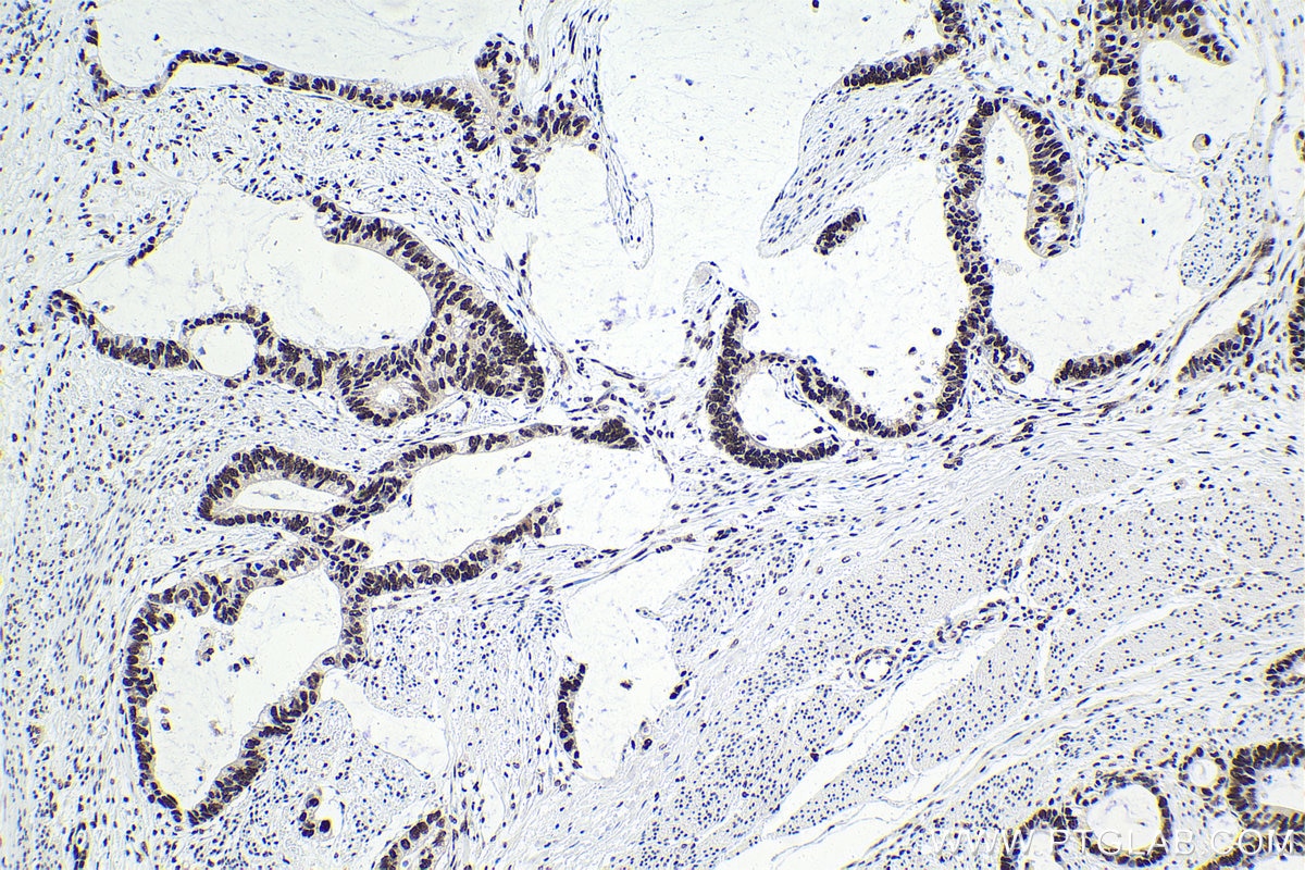 Immunohistochemical analysis of paraffin-embedded human urothelial carcinoma tissue slide using KHC1580 (CSTF2 IHC Kit).