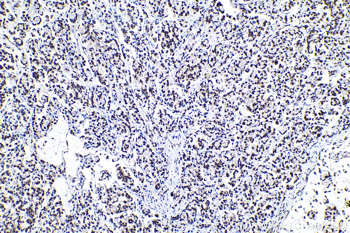 Immunohistochemical analysis of paraffin-embedded human colon cancer tissue slide using KHC0945 (CTBP1 IHC Kit).