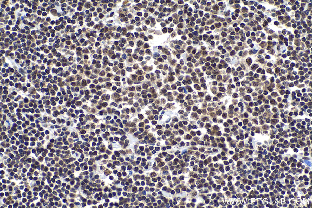 Immunohistochemical analysis of paraffin-embedded human lymphoma tissue slide using KHC0945 (CTBP1 IHC Kit).