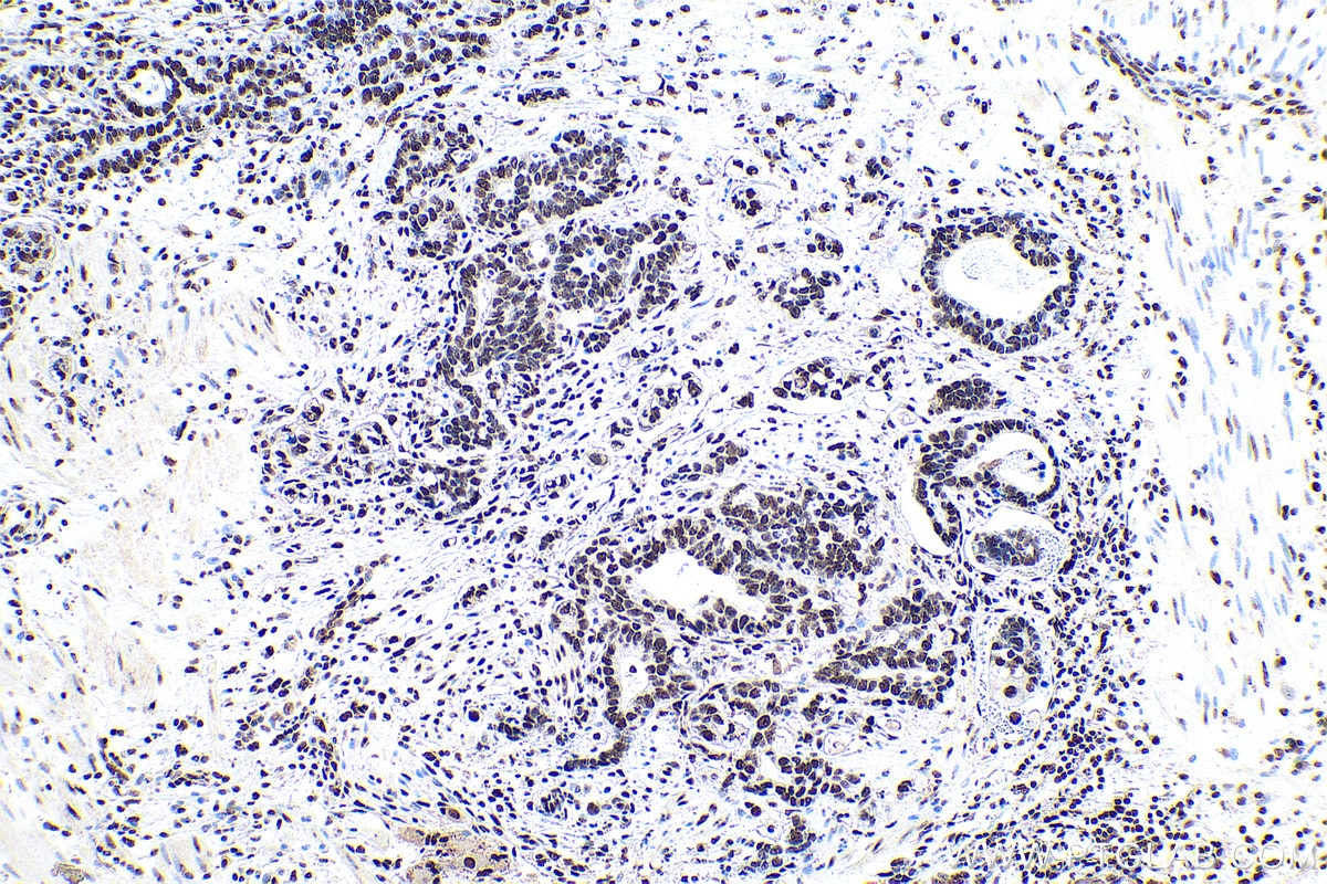 Immunohistochemical analysis of paraffin-embedded human stomach cancer tissue slide using KHC0945 (CTBP1 IHC Kit).