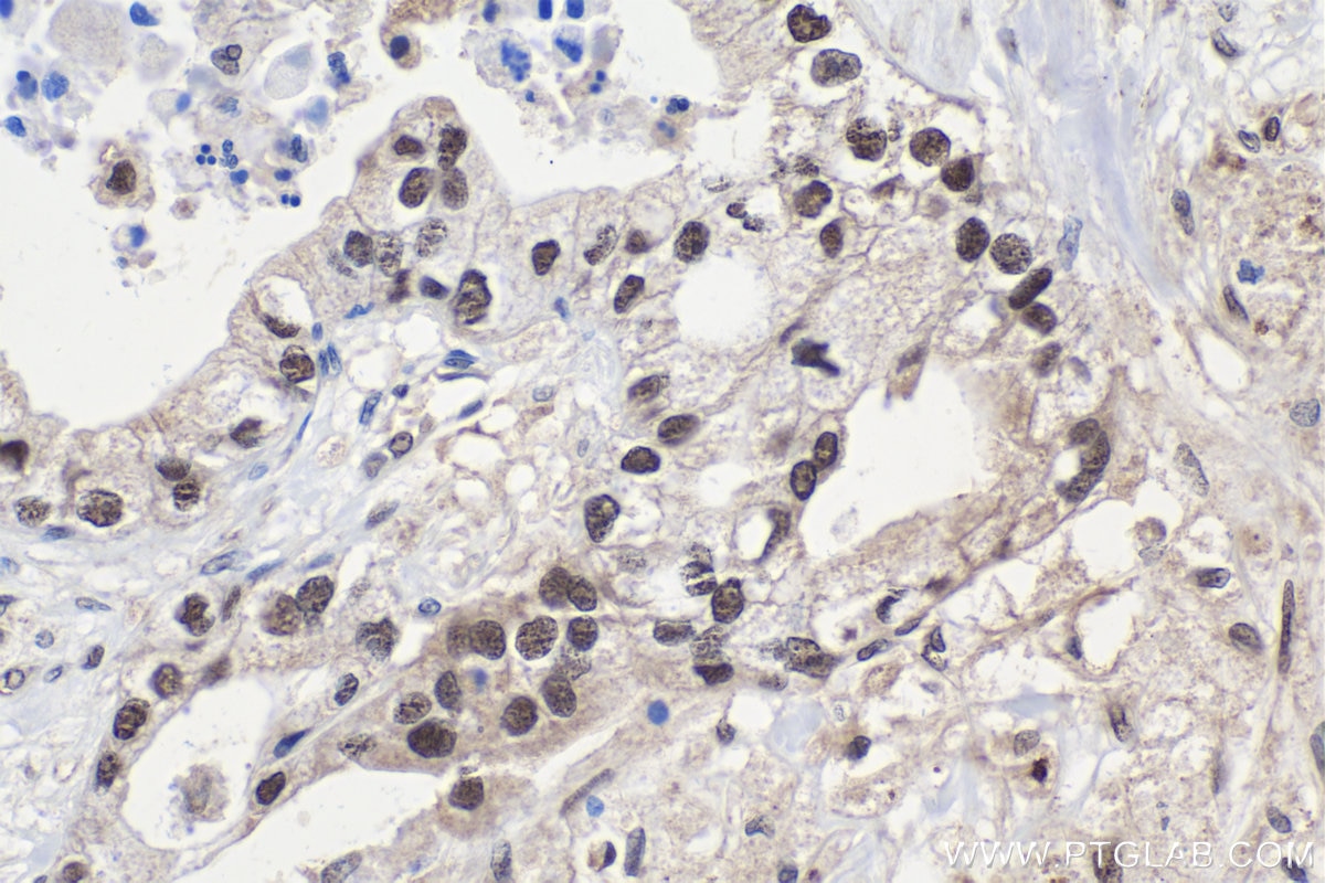 Immunohistochemical analysis of paraffin-embedded human pancreas cancer tissue slide using KHC1633 (CTBP2 IHC Kit).