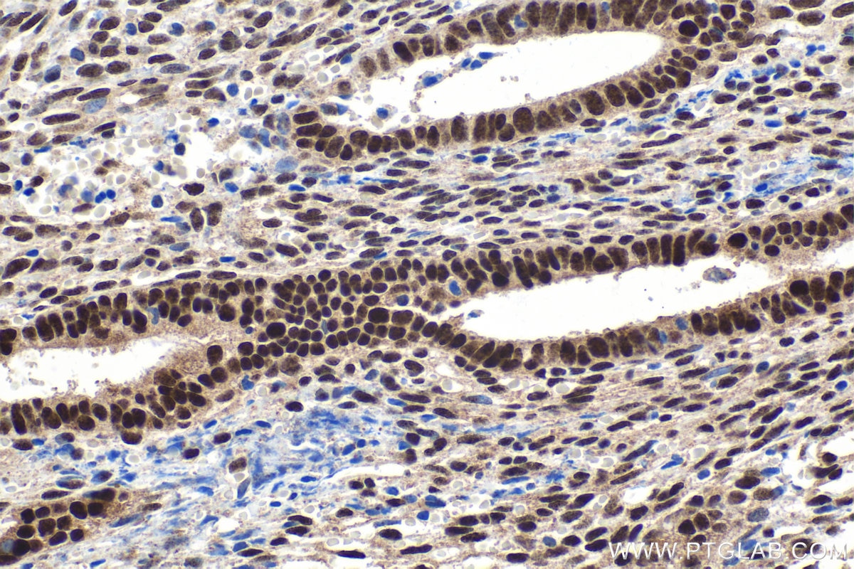 Immunohistochemical analysis of paraffin-embedded human cervical cancer tissue slide using KHC1613 (CTCF IHC Kit).