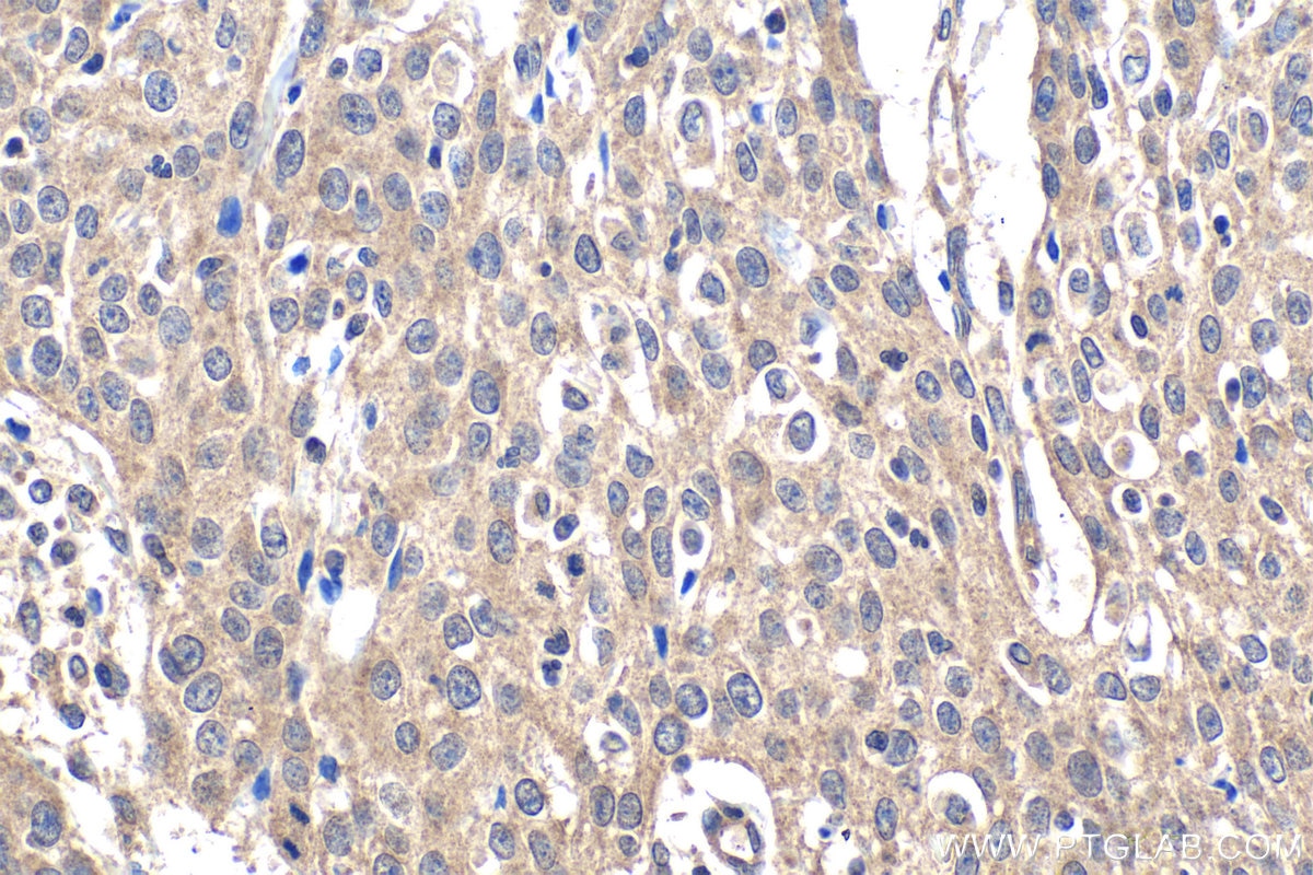 Immunohistochemical analysis of paraffin-embedded human cervical cancer tissue slide using KHC1841 (CTCFL/BORIS IHC Kit).