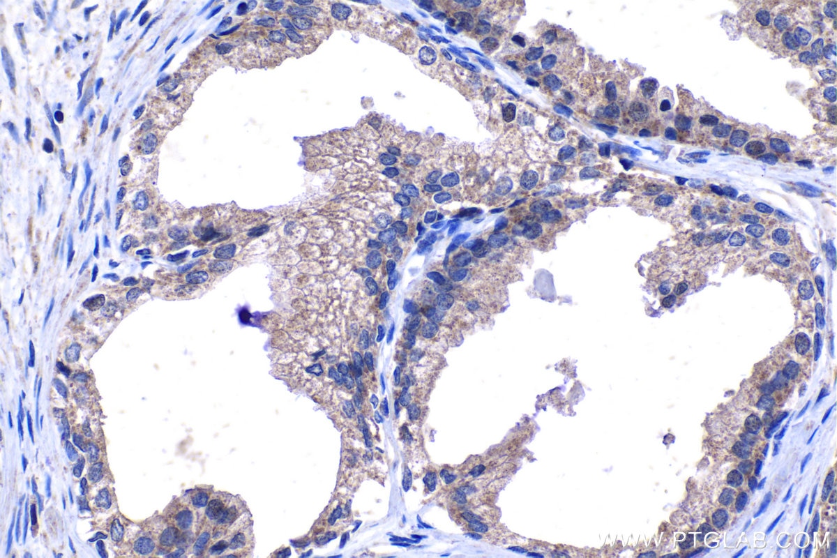 Immunohistochemical analysis of paraffin-embedded human prostate cancer tissue slide using KHC1108 (CTGF/CCN2 IHC Kit).