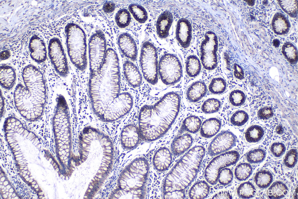 Immunohistochemical analysis of paraffin-embedded human colon cancer tissue slide using KHC1108 (CTGF/CCN2 IHC Kit).