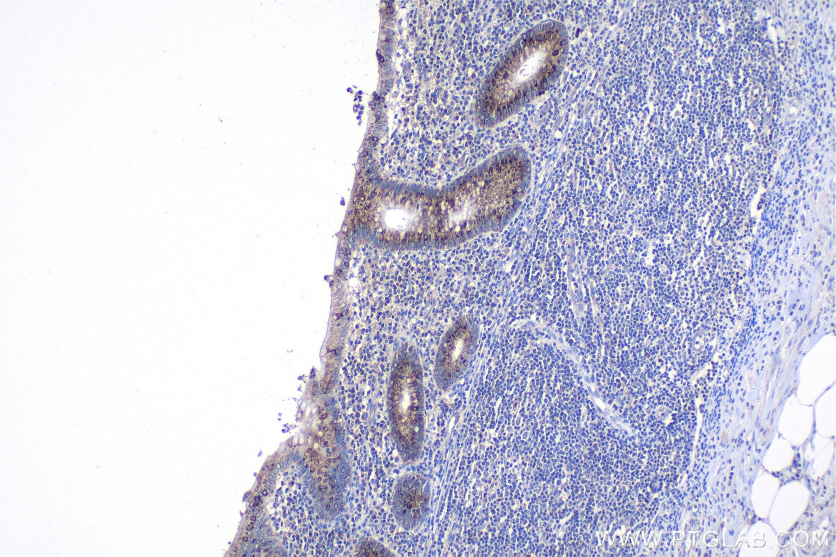 Immunohistochemical analysis of paraffin-embedded human appendicitis tissue slide using KHC1108 (CTGF/CCN2 IHC Kit).