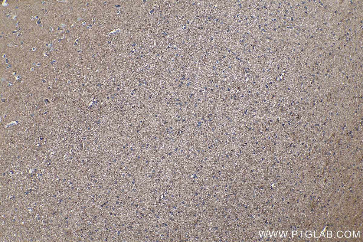 Immunohistochemical analysis of paraffin-embedded human gliomas tissue slide using KHC0261 (CTNNA2 IHC Kit).