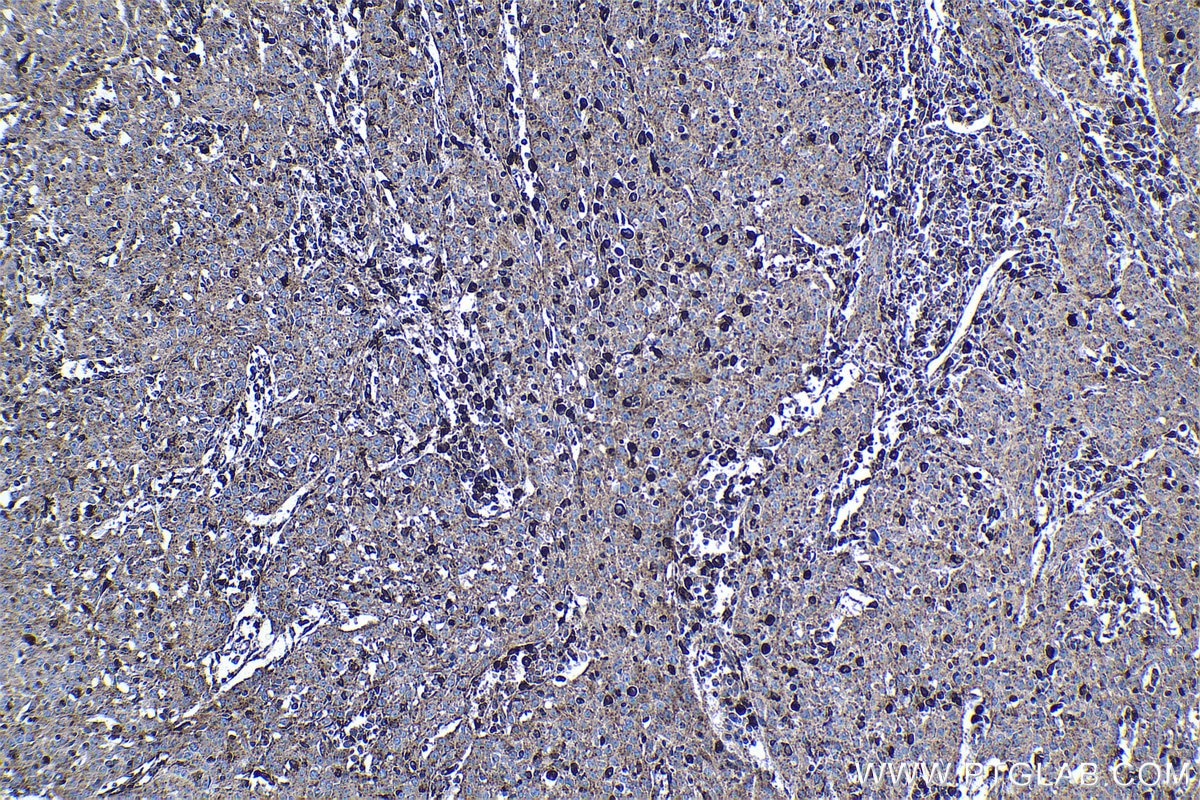 Immunohistochemical analysis of paraffin-embedded human cervical cancer tissue slide using KHC1125 (CTSA IHC Kit).