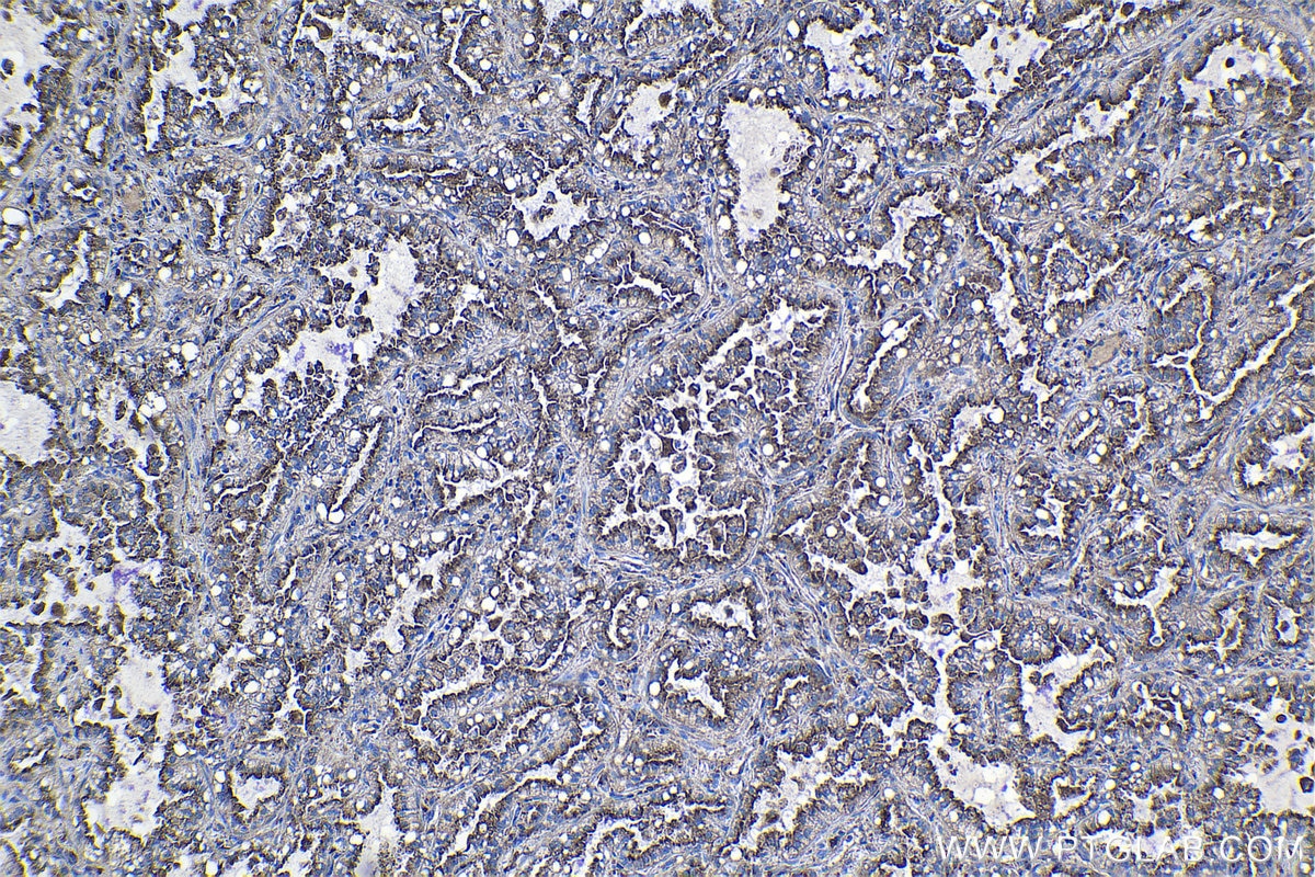 Immunohistochemical analysis of paraffin-embedded human lung cancer tissue slide using KHC1125 (CTSA IHC Kit).