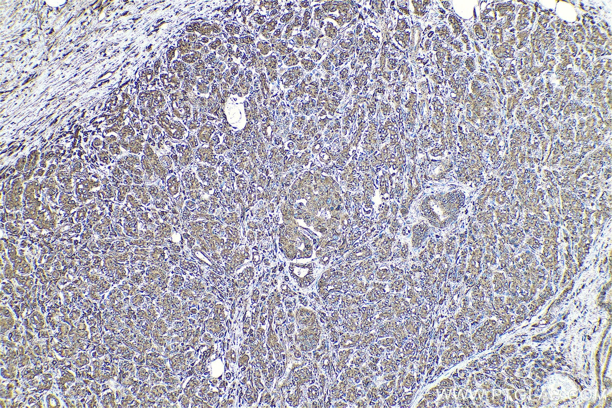 Immunohistochemical analysis of paraffin-embedded human pancreas cancer tissue slide using KHC0591 (Cathepsin D IHC Kit).