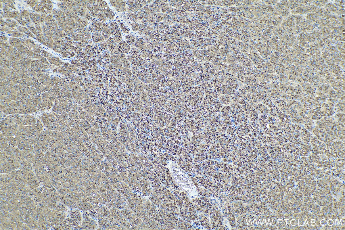 Immunohistochemical analysis of paraffin-embedded human liver cancer tissue slide using KHC0591 (Cathepsin D IHC Kit).