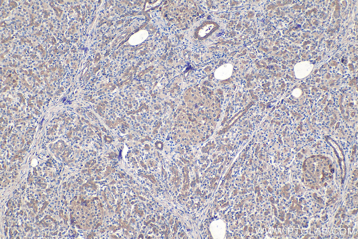 Immunohistochemical analysis of paraffin-embedded human pancreas cancer tissue slide using KHC1512 (CTSL1 IHC Kit).