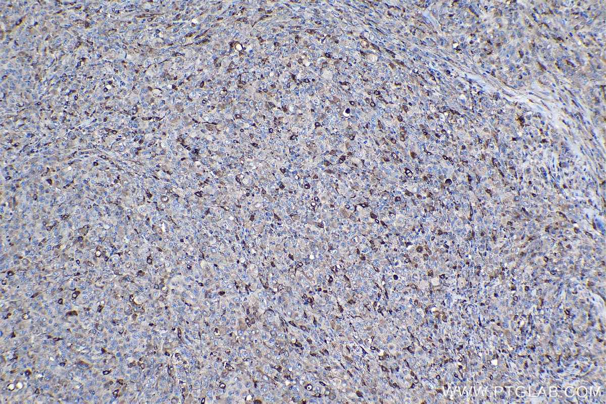 Immunohistochemical analysis of paraffin-embedded human lymphoma tissue slide using KHC0990 (CTSZ IHC Kit).