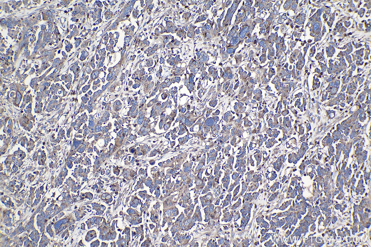 Immunohistochemical analysis of paraffin-embedded human colon cancer tissue slide using KHC0990 (CTSZ IHC Kit).