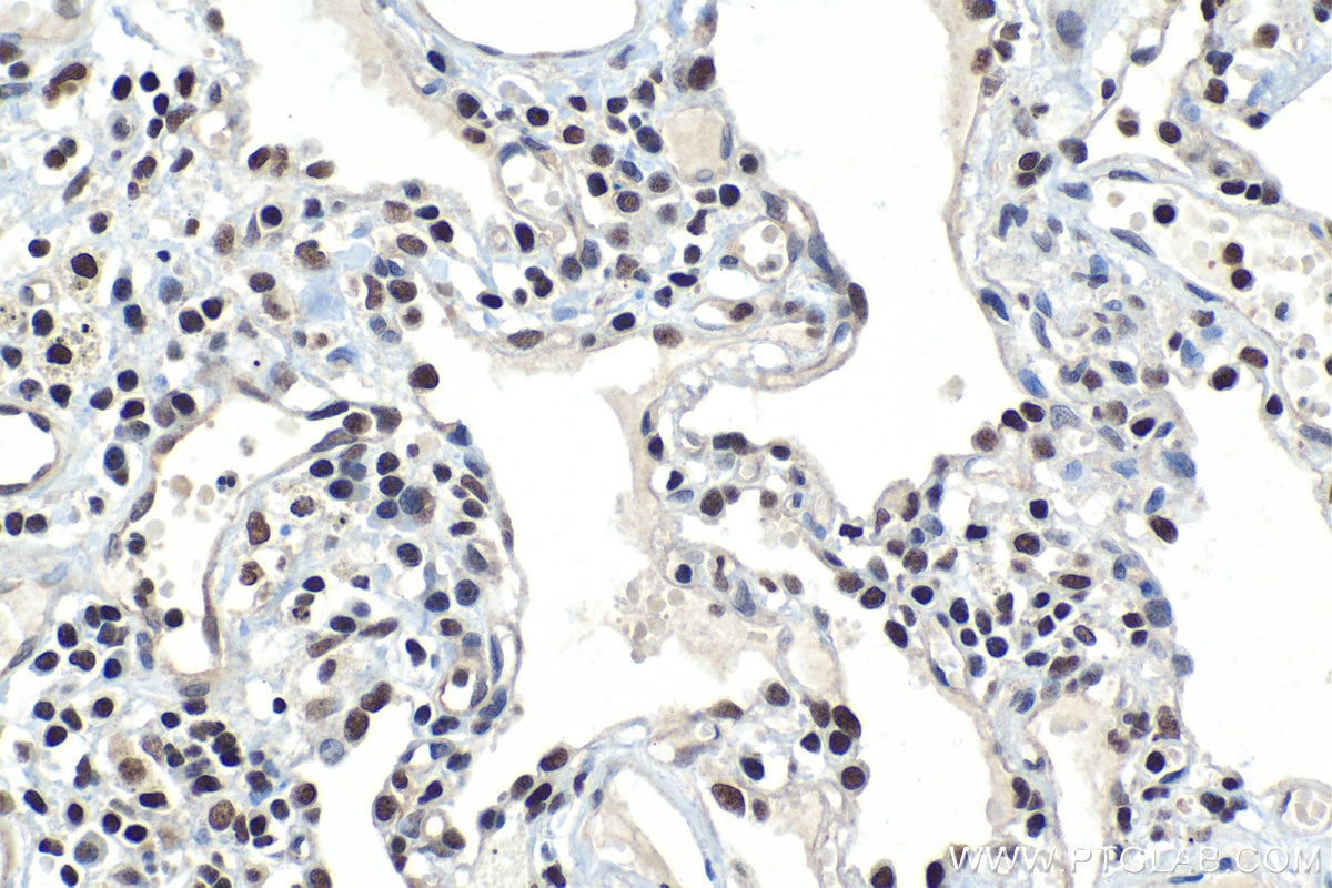 Immunohistochemical analysis of paraffin-embedded human lung cancer (ANCT) tissue slide using KHC1121 (CUGBP2 IHC Kit).