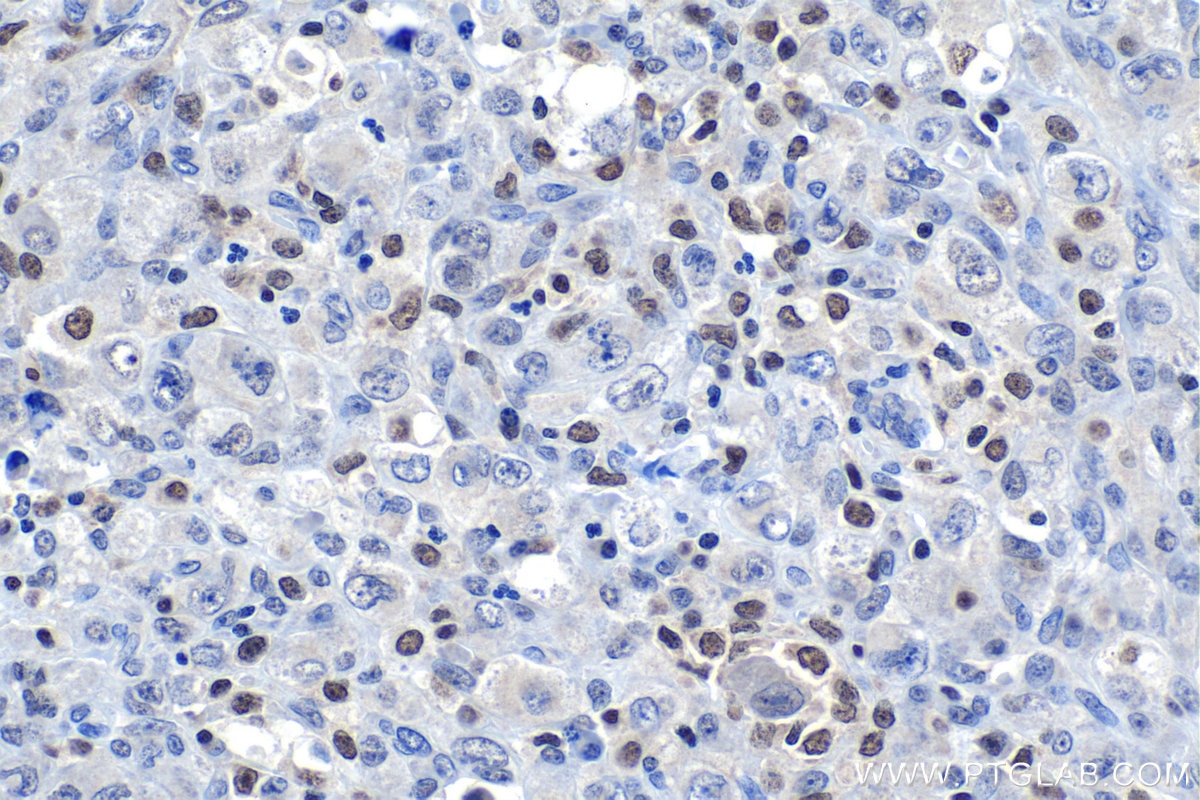Immunohistochemical analysis of paraffin-embedded human lymphoma tissue slide using KHC1121 (CUGBP2 IHC Kit).