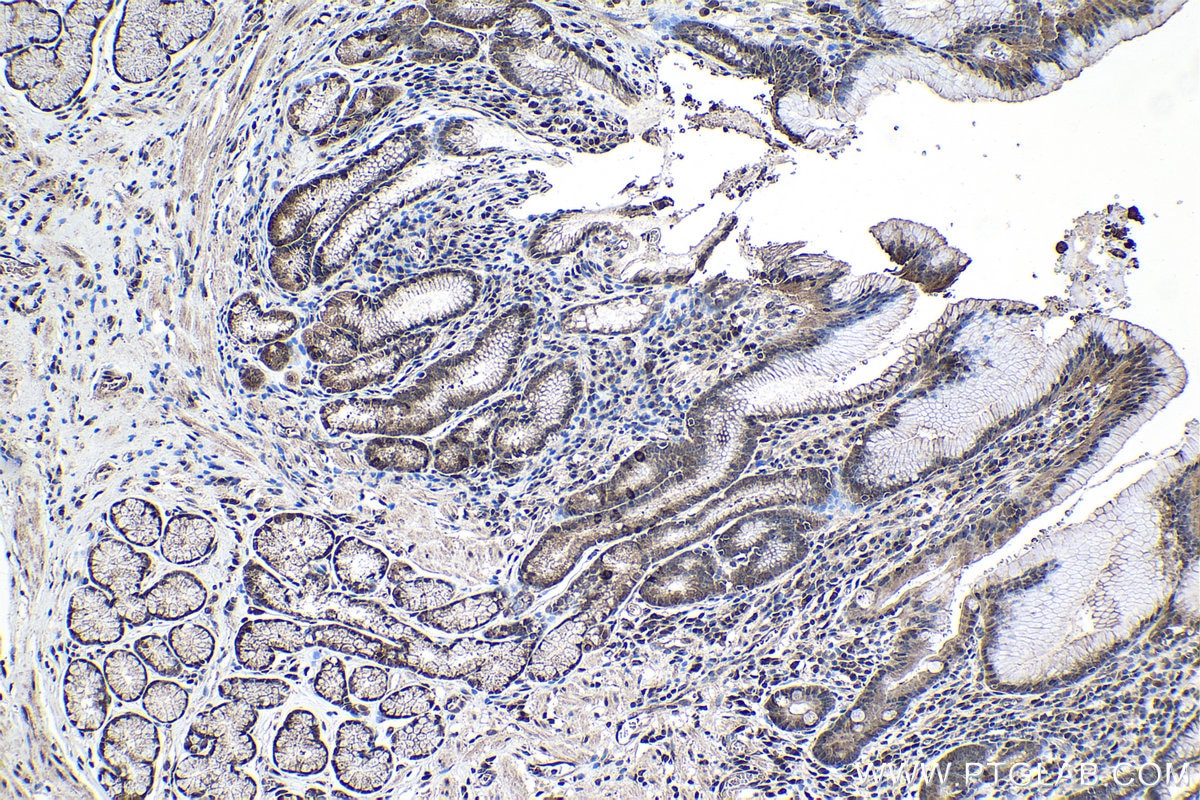 Immunohistochemical analysis of paraffin-embedded human stomach cancer tissue slide using KHC1035 (CUL1 IHC Kit).