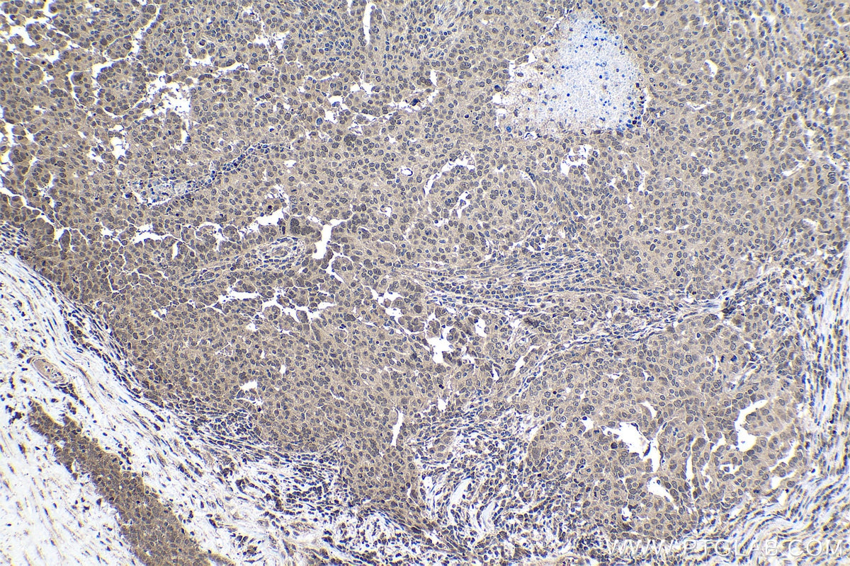 Immunohistochemical analysis of paraffin-embedded human ovary tumor tissue slide using KHC1035 (CUL1 IHC Kit).