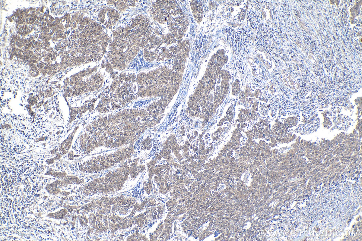 Immunohistochemical analysis of paraffin-embedded human lung cancer tissue slide using KHC1035 (CUL1 IHC Kit).