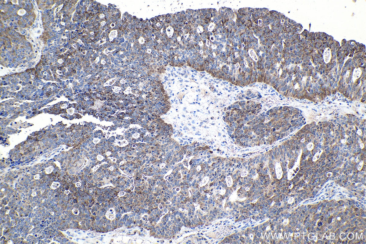 Immunohistochemical analysis of paraffin-embedded human ovary tumor tissue slide using KHC1066 (CUL3 IHC Kit).