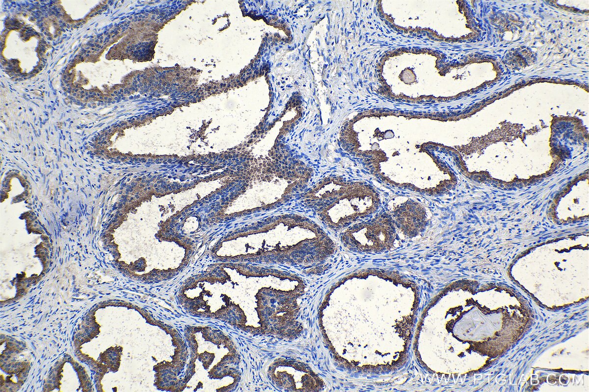 Immunohistochemical analysis of paraffin-embedded human prostate cancer tissue slide using KHC1066 (CUL3 IHC Kit).