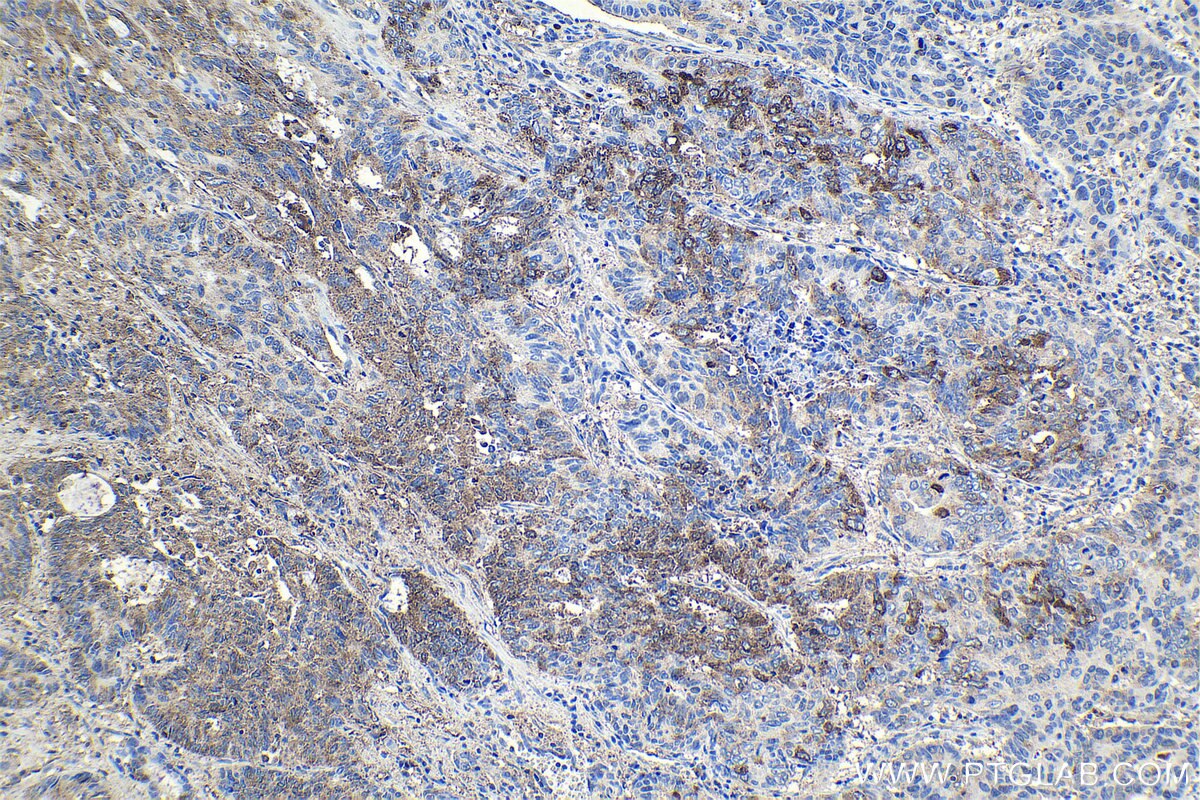 Immunohistochemical analysis of paraffin-embedded human lung cancer tissue slide using KHC1066 (CUL3 IHC Kit).