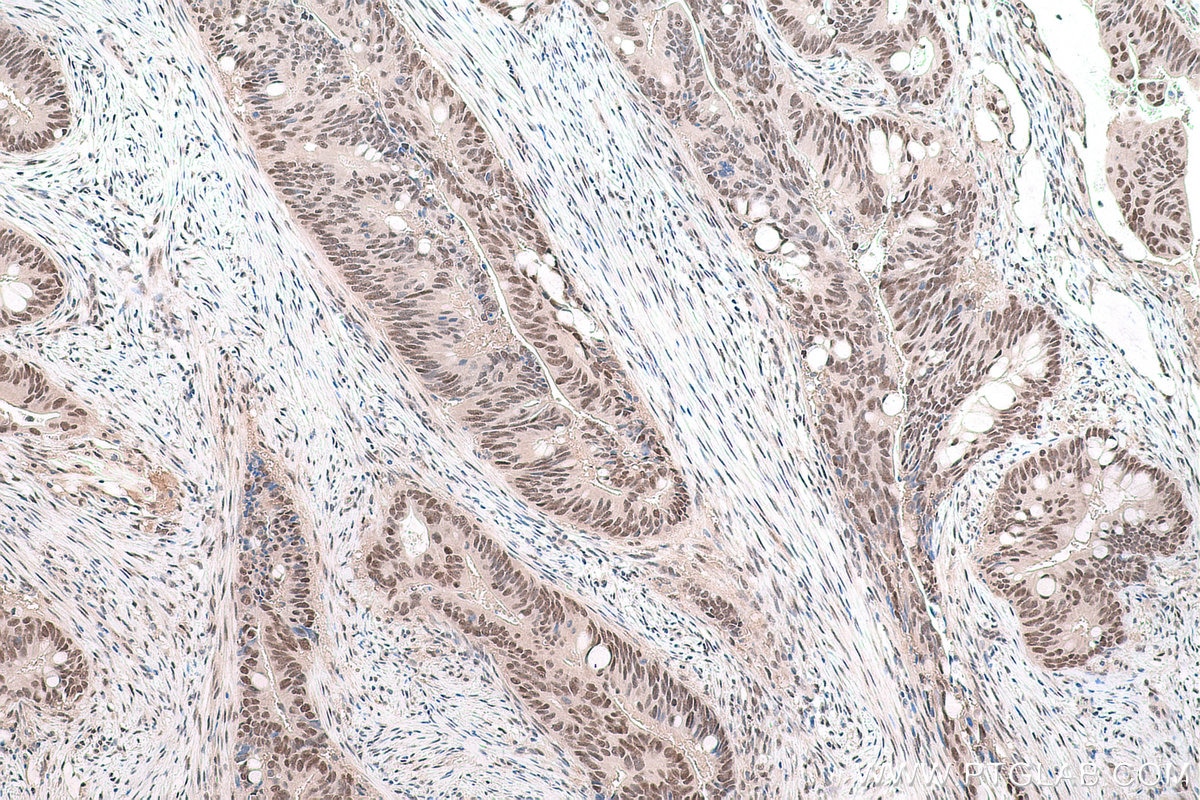 Immunohistochemical analysis of paraffin-embedded human colon cancer tissue slide using KHC1718 (CUL4B IHC Kit).
