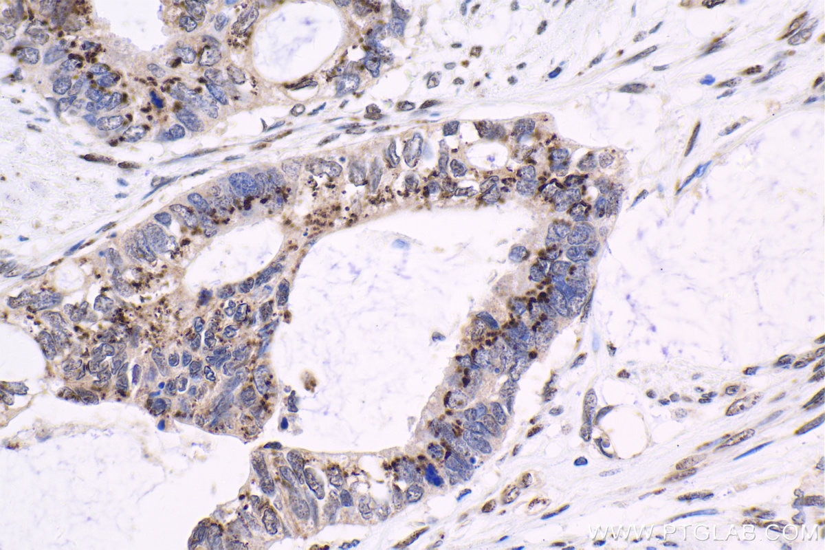 Immunohistochemical analysis of paraffin-embedded human urothelial carcinoma tissue slide using KHC1590 (CUX1 IHC Kit).