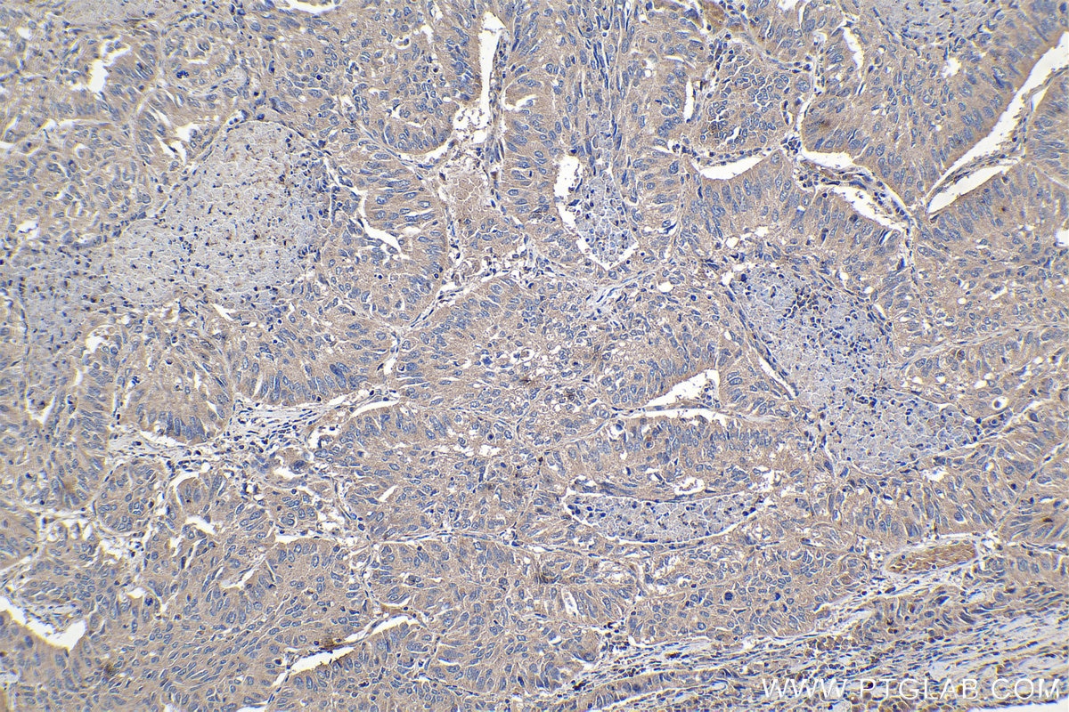 Immunohistochemical analysis of paraffin-embedded human lung cancer tissue slide using KHC1070 (CX3CL1 IHC Kit).